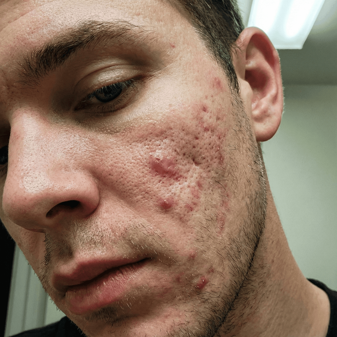 Jake before treatment